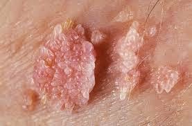 Cara Penularan Virus Hpv