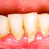 Cách chữa viêm lợi hở quanh chân răng
