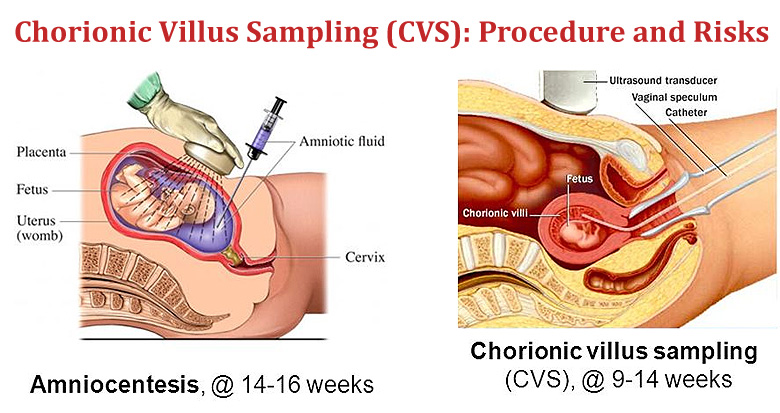 Invasive (Amniocentesis / CVS) Prenatal Testing