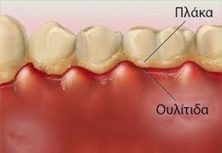 Gingivitis and periodontitis