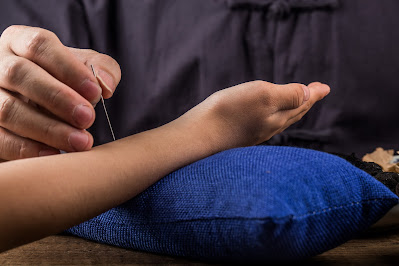 Acupuncture Therapy in Brisbane