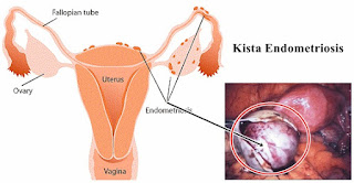 Kista Fungsional vs Kistadenoma