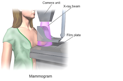 Mamogram Xray Views(picture of the breast)