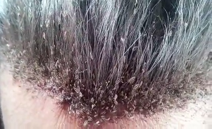 This Could Be The Most Extreme Head Lice Infestation And 