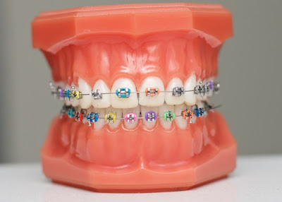 Các loại mắc cài niềng răng được chuyên gia nha khoa khuyên dùng