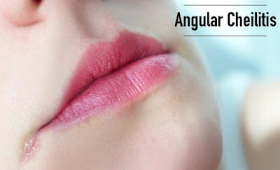 Cara Mengatasi Dan Mengobati Luka Disudut Bibir (Angular Cheilitis)