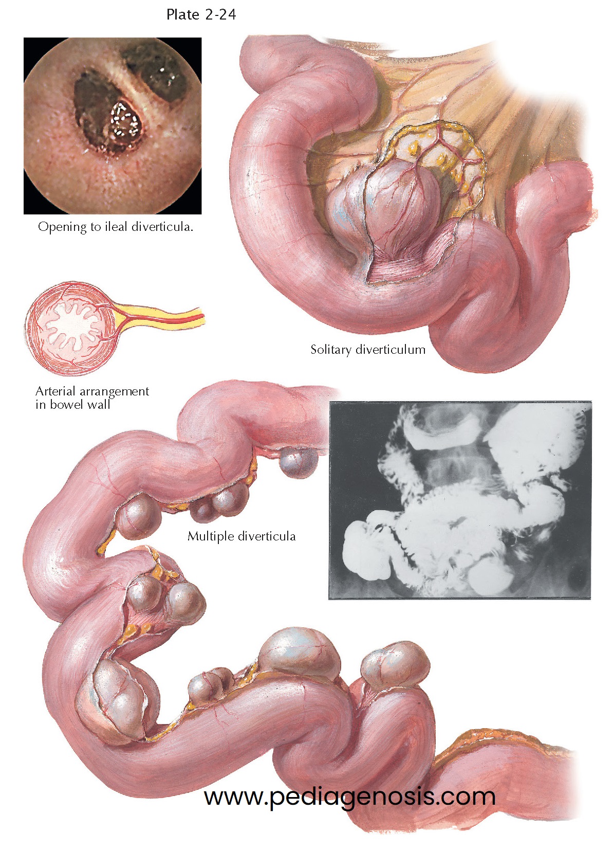 Diverticula of Small Intestine