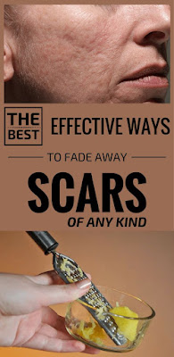 The Best Effective Ways To Fade Away Scars Of Any Kind!!!