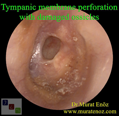 Tympanic membrane perforation - damaged ossicles