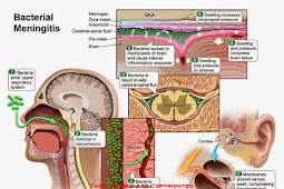 Bacterial of Meningitis