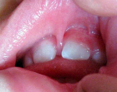 Does Upper Lip Tie Removal Help Prevent Upper Front Teeth Gap? | Fauquier ENT Blog Does Upper Lip Tie Removal Help Prevent Upper Front Teeth Gap? | Fauquier ENT Blog