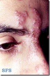 acupuntura curitiba herpes zoster 3