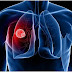 Punca dan Cara Mencegah Kanser Paru-paru