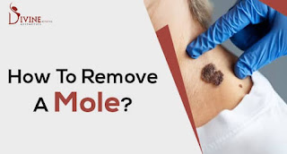 Best Mole Removal Doctor in Delhi