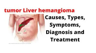 What Is Liver Hemangioma