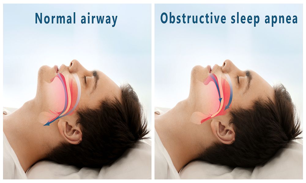 Obstructive Sleep Apnea