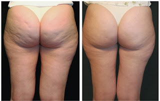 eliminate Cellulite On Bum 