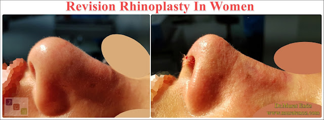 Revision Nose Job Surgery For Women in Istanbul - Revision Female Rhinoplasty in Istanbul - Women's Revision Rhinoplasty in Turkey - Revision Nose Reshaping For Women in Istanbul - Revision Nose Job Rhinoplasty For Women in Istanbul - Best Revision Rhinoplasty For Women Istanbul - Revision Nose Aesthetic For Women in Istanbul - Female Revision Nose Operation in Istanbul - Female Revision Rhinoplasty Surgery in Istanbul - Female Revision Rhinoplasty Surgery in Turkey - Female Revision Nose Aesthetic Surgery in Istanbul - Revision Rhinoplasty In Women Istanbul