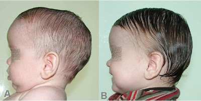 Paciente con Escafocefalia. A. 5 meses de edad, imagen preoperatoria, B. Imagen a los 9 meses post cirugía y con tratamiento de DOC-Band® durante 2 meses.
