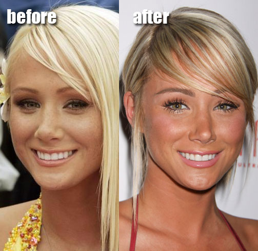 before and after nose jobs celebrity. efore and after nose job
