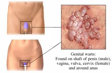 {Cara Pengobatan Penyakit Kutil Kelamin|Obat Penyakit Kelamin Seperti Kutil|Gambar Kutil Di Kemaluan Pria|Foto Kutil Di Anus|Opasnost Kondiloma|Virus Penyebab Kondiloma Akuminata|Kutil Kelamin Condyloma Acuminata|Kutil Kelamin Yang Masih Kecil|Petua Hilangkan Ketuat Kemaluan|Kondiloma Pada Pria|Obat Kutil Di Daerah Anus|Menghilangkan Kutil Kemaluan|Kutil Kelamin Pada Ibu Hamil|Cara Menghilangkan Ketuat Kelamin|Kutil Kelamin Saat Hamil|Gambar Penyakit Kutil Kemaluan|Lidah Buaya Obat Kutil Kelamin|Krim Untuk Kutil Kelamin|Apa Itu Hpv Test|Berbahayakah Kutil Kelamin|Obat Alami Kutil Jengger Ayam|Kutil Kelamin Berdarah|Obat Kutil Kelamin Yang Di Jual Di Apotek|Kutil Kelamin Gejala Hiv|Kutil Kelamin Tidak Gatal|Apa Itu Hpv Pada Pria|Cara Menyembuhkan Kutil Kelamin Dengan Alami|Kutil Kelamin Dengan Cuka Apel|Obat Apotik Untuk Kondiloma Akuminata|Kutil Kelamin Sering Kambuh|Gejala Penyakit Kutil Kelamin Pria|Obat Kondiloma Untuk Ibu Hamil|Obat Alami Kutil Kelamin Obat Alami Kutil Kelamin|Apakah Kutil Kelamin Bisa Sembuh Sendiri|Kutil Kelamin Dapat Sembuh Sendiri|Ciri Condyloma|Cara Mengatasi Penyakit Hpv|Kutil Kelamin Di Laser|Apotik Jual Obat Kutil Kelamin|Apa Itu Injection Hpv|Mengobati Kutil Pada Kelamin|Menghilangkan Hpv|Gambar Kutil Kelamin Tahap Awal|Bagaimana Cara Penyembuhan Kutil Kelamin|Mengenali Gejala Kutil Kelamin|Gejala Penyakit Ketuat Kemaluan|Kutil Kelamin Di Buah Zakar|Gambar Kutil Di Anus|Gejala Hpv|Penyebab Kutil Kelamin Pada Wanita|Gambar Gambar Kutil Kelamin|Kutil Kelamin Cara Mengobati|Pengobatan Kutil Kelamin Di Rumah|Efek Kondiloma Pada Janin|Obat Kutil Kelamin Di Jogja|Human Papillomavirus Hpv Prevention|Cara Mengobati Penyakit Kondiloma Akuminata|Obat Kutil Wajah Alami|Apa Itu Hpv Virus|Kutil Kelamin Di Lidah|Kumpulan Obat Kutil Di Wajah|Pantangan Makan Untuk Penyakit Kutil Kelamin|Cara Menghilangkan Penyakit Kutil Kelamin|Apa Itu Virus Kondiloma|Ciri Penyakit Jengger Ayam|Obat Kutil Untuk Wajah|Penyakit Kutil Kelamin Pada Perempuan|Penyakit Kutil Kelamin Apakah Berbahaya|Obat Kutil Scara Alami|Apa Itu Kondiloma Lata|Kutil Kelamin Cara Penyembuhan|Obat Ketuat Kemaluan Tanpa Operasi|Cara Alami Mengobati Kutil Kelamin Pria|Apakah Kutil Kelamin Dapat Sembuh Total|Apakah Virus Hpv Bisa Sembuh Total|Obat Oles Kondiloma|Kondiloma Di Mulut|Crystal X Bisa Mengobati Kutil Kelamin|Pengobatan Hpv Pria|Kutil Kelamin Bagi Ibu Hamil|Nama Salep Buat Kutil Kelamin|Apakah Jengger Ayam Menular|Cara Mengobati Kutil Kelamin Dengan Bahan Alami|Cara Mengobati Kutil Kelamin Pada Wanita Hamil|Obat Alami Untuk Kutil Kemaluan|Nama Obat Kutil Di Kelamin|Penyebab Kondiloma Pada Wanita|Penyebab Kutil Pada Kemaluan Wanita|Bagaimana Cara Menghilangkan Kutil Kelamin|Obat Kutil Kelamin Yg Ada Di Apotik|Obat Kutil Kelamin Medis|Gambar Kutil Kelamin Condiloma|Salep Untuk Jengger Ayam|Cara Mengobati Kutil Kelamin Pria|Foto Kutil Kelamin Pada Wanita|Ketuat Di Kemaluan Wanita|Mengobati Kutil Kelamin Dengan Cuka Apel|Bakteri Penyebab Kutil Kelamin|Cara Mengobati Kutil Kemaluan Dengan Bawang Putih|Apa Yang Dimaksud Kondiloma Akuminata|Gambar Penyakit Hpv|Gambar Kutil Kelamin Perempuan|Kondiloma Adalah Penyakit|Obat Kutil Kelamin Di Semarang|Human Papillomavirus Hpv Pictures|Kondiloma Akuminata Pada Wanita Hamil|Pengobatan Kutil Kelamin Dokter|Gambar Penyakit Jengger Ayam|Obat Kutil Genital|Cara Menghilangkan Kutil Kelamin Alami|Obat Alami Atasi Kutil Kelamin|Kutil Di Kemaluan|Beli Obat Jengger Ayam|Apa Arti Kondiloma|Obat Alami Untuk Menghilangkan Kutil Kelamin|Apa Itu Penyakit Kondiloma Akuminata|Obat Kutil Kelamin Murah|Obat Penyakit Kutil Kelamin|Kutil Kelamin Warna Hitam|Cara Menyembuhkan Kutil Di Kelamin Secara Alami|Obat Kutil Atau Mata Ikan|Ketuat Kemaluan Lelaki|Obat Penyakit Kutil Kelamin Di Apotik|Obat Resep Dokter Untuk Kutil Kelamin|Obat Herbal Kutil Kelamin Wanita|Cara Mengobati Penyakit Kutil Pada Kelamin Pria|Apakah Kutil Kelamin Bisa Sembuh|Ketuat Di Kemaluan|Apotik Yang Menjual Obat Kutil Kelamin|Salep Mengobati Kutil Kelamin|Obat Kutil Untuk Di Muka|Cara Mengobati Kutil Kelamin Secara Alami|Ciri Ciri Penyakit Kutil Pada Kelamin Pria|Penyebab Penyakit Kutil Pada Kelamin Pria|Kondiloma Di Dubur|Cara Merontokan Kondiloma|Obat Cina Untuk Kutil Kelamin|Pengobatan Kutil Kemaluan|Nama Penyakit Kutil Kelamin|Apakah Kutil Kelamin Berbahaya|Bagaimana Cara Menghilangkan Virus Hpv|Kondiloma Pada Persalinan|Obat Antibiotik Untuk Kutil Kelamin|Penyakit Kutil Kelamin Bisa Sembuh|Obat Kutil Alami Yang Ampuh|Gambar Kutil Kelamin Wanita|Gejala Penyakit Kutil Kelamin Pada Wanita|Obat Kimia Untuk Kutil Kelamin|Gambar Obat Kutil|Nama Obat Untuk Kutil Kelamin Di Apotik|Salep Kutil Kelamin Yang Dijual Diapotik|Dampak Kondiloma Akuminata Pada Janin|Kutil Kelamin Propolis|Obat Kutil Pada Tangan|Apakah Hpv Bisa Sembuh Total|Gambar Gejala Awal Kutil Kelamin|Obat Kutil Kelamin Di Bali|Obat Kutil Dari Dalam|Obat Menghilangkan Kutil Di Anus|Obat Untuk Menghilangkan Ketuat|Kutil Kelamin Bisa Sembuh Dengan Sendirinya|Pengobatan Alternatif Virus Hpv|Obat Salep Kondiloma Akuminata|Obat Kutil Apa|Obat Kutil Air|Obat Herbal Kutil Di Anus|Obat Kutil Hpv|Penyebab Penyakit Kondiloma Akuminata|Bahaya Kutil Kelamin Pada Ibu Hamil|Cara Alami Obat Kutil Kelamin|Kumpulan Obat Kutil Kelamin Di Apotik|Obat Penyakit Kutil Kelamin Pria|Obat Medis Untuk Kutil Kelamin|Kutil Kelamin Seperti Apa|Kutil Kelamin Obat Alami|Kutil Kelamin Bisa Disembuhkan Atau Tidak|Bahan Obat Kutil Kelamin|Mengatasi Kutil Pada Kelamin|Obat Kutil Di Wajah|Herpes Genital Dan Penyakit Kutil Kelamin|Obat Kutil Di Jari Tangan|Obat Kondiloma Kutil Kelamin Jengger Ayam|Obat Kutil Jengger|Menghilangkan Kutil Di Kemaluan Wanita|Cara Menghilangkan Kutil Kelamin Pria Secara Alami|Cara Menyembuhkan Ketuat Kelamin|Cara Mengobati Kutil Kelamin Sendiri|Nama Salep Kutil Kelamin Di Apotik|Kutil Kelamin Bawang Putih|Cara Menghilangkan Kutil Kemaluan Dengan Bawang Putih|Obat Menghilangkan Kutil Di Leher|Kutil Kelamin Masih Kecil|Kutil Kelamin Bisa Sembuh Sendiri|Kutil Kelamin Sembuh Dengan Bawang Putih|Penyebab Kutil Kelamin Perempuan|Penyebabnya Kutil Kelamin|Nama Salep Kutil Kelamin|Penyebab Terjadinya Penyakit Kutil Kelamin|Kutil Kelamin Yang Tidak Gatal|Obat Kutil Dan Mata Ikan|Cara Mengobati Kutil Kelamin Pd Wanita|Pengobatan Kondiloma Pada Pria|Berapa Lama Pengobatan Kutil Kelamin|Pengobatan Alternatif Hpv|Kumpulan Obat Penyakit Kondiloma|Menyembuhkan Kondiloma|Cara Mengatasi Kutil Pada Kelamin Pria|Apakah Kutil Kelamin Menyebabkan Keputihan|Cara Menyembuhkan Kutil Kemaluan|Obat Kutil Obat Kutil|Penyebab Ada Nya Kutil Kelamin|Cara Menghilangkan Virus Kutil Kelamin|Kondiloma Bisa Hilang Sendiri|Cara Menghilangkan Kutil Pada Alat Kelamin|Kondiloma Penyakit Apa|Obat Alami Untuk Kutil Di Kelamin|Kondiloma Pada Laki Laki|Cara Menghilangkan Kutil Di Anus|Pengobatan Alami Penyakit Kutil Kelamin|Obat Ampuh Ngilangin Kutil|Obat Salep Buat Kutil Kelamin|Penyebab Dan Gejala Penyakit Kutil Kelamin|Masa Penularan Kutil Kelamin|Obat Kutil Kelamin Tradisional Yang Ampuh|Cream Perontok Hpv|Menghilangkan Kutil Kelamin Dengan Kulit Pisang|Obat Luar Kutil|Apa Suntikan Hpv|Cara Menghilangkan Kutil Di Bagian Kelamin|Gambar Kutil Kemaluan Wanita|Kondiloma Akuminata Pada Kehamilan|Obat Kutil Kelamin Dengan Cuka|Kutil Di Dalam Anus|Kutil Kelamin Bisa Hilang|Obat Tradisional Penghilang Kutil Kelamin|Apakah Kondiloma Akuminata Bisa Sembuh|Apakah Penyakit Kutil Kelamin Berbahaya|Harga Obat Jengger Ayam|Gambar Ketuat Di Kemaluan|Pantangan Untuk Penyakit Kutil Kelamin|Salep Untuk Menghilangkan Kutil Kelamin|Salep Untuk Mengobati Kutil Kelamin|Gejala Klinis Pada Penyakit Kondiloma Akuminala|Obat Kutil Kelamin Ampuh|Jual Obat Ketuat Kemaluan|Tanaman Obat Untuk Menghilangkan Kutil Kelamin|Harga Salep Kutil Kelamin|Obat Kutil Hansaplast|Obat Kutil Farmasi|Faktor Penyebab Kondiloma Akuminata|Obat Kutil Di Venis|Cara Alami Mengobati Hpv|Mengobati Kutil Kelamin Dengan Lidah Buaya|Pengalaman Operasi Kutil Kelamin|Bahaya Kondiloma|Pengobatan Ketuat Kemaluan Pria|Obat Kutil Kelamin Murah Meriah|Obat Kutil Cream|Kutil Kelamin Obat Nya|Pengobatan Alternatif Jengger Ayam|Fakta Kutil Kelamin|Apa Itu Kutil Kemaluan|Cara Menghilangkan Bekas Kutil Kelamin|Kutil Kelamin Yang Baru Muncul|Penyebab Penyakit Kutil Kemaluan|Obat Kutil De Nature Indonesia|Obat Kutil Secara Medis|Obat Tradisional Kutil Di Anus|Apakah Kondiloma Bisa Sembuh|Menghilangkan Kutil Kelamin Dengan Kapur|Mengobati Kutil Kelamin Tradisional|Bentuk Kondiloma Akuminata|Gambar Kutil Kelamin Kesehatan|Berapa Harga Operasi Kutil Kelamin|Pengobatan Penyakit Kutil Kelamin Pada Pria|Apakah Kutil Kelamin Itu Berbahaya|Beda Kondiloma Lata Dan Akuminata|Kutil Dalam Anus|Pengobatan Alternatif Kutil Kelamin|Apa Yang Dimaksud Dengan Kondiloma Akuminata|Foto Obat Kutil|Testimoni Kondiloma|Gejala Gejala Klinis Penyakit Kondiloma Akuminala|Obat Kutil Jengger Ayam|Apakah Kondiloma Bisa Hilang Sendiri|Nama Obat Kutil Di Apotik|Obat Kutil Sabun Colek Dan Kapur Sirih|Obat Kutil Beranak|Obat Kutil Berakar|Efek Penyakit Kutil Kelamin|Penyebab Kutil Kelamin Dan Penyembuhannya|Cream Perontok Ketuat Kemaluan|Operasi Kutil Kelamin Dengan Bpjs|Obat Herbal Kutil Kelamin|Human Papillomavirus Hpv Vaccine Side Effects|Apakah Kutil Pada Kelamin Berbahaya|Kondiloma Sembuh Sendiri|Kumpulan Obat Kutil Di Kemaluan|Nama Obat Kondiloma|Kutil Kelamin Dan Kencing Nanah|Jenis Obat Kutil Kelamin|Cara Mengobati Kondiloma|Mengobati Kutil Di Kemaluan|Obat Kondiloma De Nature|Faktor Risiko Kondiloma|Mengobati Kutil Kelamin Dengan Cuka|Gejala Gejala Kutil Kelamin|Pengobatan Kutil Kelamin Pada Ibu Hamil|Mengatasi Kutil Di Kemaluan|Penularan Penyakit Kondiloma Akuminata|Kondiloma Pada Kehamilan|Obat Tradisional Kutil Kelamin Pada Pria|Apa Itu Penyakit Kelamin Jengger Ayam|Ciri Kutil Kelamin|Obat Kutil Kelamin Dari Dalam|Jual Obat Kutil Kelamin Wanita|Cara Mengatasi Ketuat Kelamin|Cara Mengobati Kutil Kelamin Dengan Tumbuhan|Gejala Kondiloma Pada Wanita|Kutil Kelamin Dan Bawang Putih|Kutil Kelamin Tidak Bahaya|Apakah Itu Suntikan Hpv|Penyakit Kutil Pada Kemaluan Pria|Apakah Kutil Kelamin Menyebabkan Gatal|Kondiloma Pada Anak|Pengobatan Kutil Di Kelamin|Obat Kutil Pada Kemaluan Wanita|Obat Tradisional Untuk Kondiloma|Kutil Kelamin Atau Jengger Ayam|Harga Obat Ketuat Kemaluan|Terapi Kondiloma Akuminata Pada Kehamilan|Cara Cepat Menyembuhkan Kutil Kelamin|Operasi Ketuat Kemaluan|Mencegah Penyakit Kutil Kelamin|Kutil Kelamin Tumbuh Lagi|Gambar Kutil Kelamin Yang Baru Tumbuh|Obat Kutil Paling Bagus|Kutil Kelamin Dan Cara Mengatasinya|Pengobatan Kutil Kelamin|Ada Kutil Di Anus|Hpv 16 Dan 18 Adalah|Kondiloma Pada Bayi|Obat Topikal Kondiloma|Cara Mengobati Kutil Di Kemaluan Pria Dengan Bawang Putih|Operasi Kondiloma Akuminata|Cara Alami Merontokan Kutil Kelamin|Obat Virus Kutil Kelamin|Gejala Ketuat Kemaluan|Tumbuhan Obat Kutil Kelamin|Kutil Kelamin Tidak Menular|Obat Penyakit Ketuat Kemaluan|Penyebab Kutil Kelamin Dan Pengobatannya|Obat Salep Kutil Kelamin Di Apotik|Cuka Apel Untuk Menghilangkan Kutil Kelamin|Bahaya Kutil Kelamin Untuk Ibu Hamil|Kutil Kelamin Karena Wc Umum|Cara Pengobatan Kutil Kelamin Pada Wanita|Efek Samping Obat Kutil Kelamin|Obat Salep Untuk Kutil Kelamin|Jengger Ayam Bisa Disembuhkan|Menghilangkan Kondiloma|Bahaya Kutil Kelamin Jika Tidak Diobati|Cara Mengobati Kutil Di Kemaluan|Kutil Kelamin Pada Wanita Hamil|Cara Alami Mengatasi Kondiloma|Mengobati Kutil Pada Kelamin Pria|Cara Menyembuhkan Kutil Kelamin Alami|Kutil Kelamin Kambuh|Kutil Kelamin Mengecil|Obat Kutil Kelamin Jakarta|Cream Kondiloma|Kutil Kelamin Ciri Ciri|Kutil Kelamin Bahaya Atau Tidak|Cara Menyembuhkan Kutil Kelamin Dengan Cepat|Obat Tradisional Untuk Penyakit Kutil Kelamin|Kondiloma Pria|Kutil Kondiloma|Gambar Kutil Dialat Kelamin|Apakah Kondiloma Bisa Hilang|Makanan Untuk Mengobati Kutil Kelamin|Cara Menghilangkan Virus Hpv Di Dalam Tubuh|Cara Mengobati Kondiloma Secara Alami|Obat Kutil Terbaru|Obat Kutil Terbaik|Apakah Kutil Kelamin Bisa Menyebabkan Hiv|Penyebab Kondiloma Akuminata|Ketuat Pada Kemaluan|Ketuat Di Bahagian Kemaluan|Kutil Di Anus Terbaru|Pengertian Dari Penyakit Kutil Kelamin|Gambar Kutil Pada Kelamin|Gejala Pertama Kutil Kelamin|Obat Kutil Di Kemaluan Wanita|Apa Itu Tes Hpv|Obat Kutil Di Muka|Cara Menyembuhkan Penyakit Hpv|Tips Menghilangkan Kutil Di Kelamin|Obat Kutil Kemaluan Pria|Kondiloma Akuminata Youtube|Efek Kutil Kelamin Pria|Cara Mengobati Kutil Kelamin Dengan Propolis|Cara Menghilangkan Kutil Kelamin Secara Cepat Dan Alami|Gejala Kutil Kelamin Pada Laki Laki|Menghilangkan Kutil Kelamin Secara Tradisional|Apa Penyebab Penyakit Kondiloma|Penyakit Kutil Kelamin Perempuan|Bekas Operasi Kutil Kelamin|Penyebab Dan Cara Me