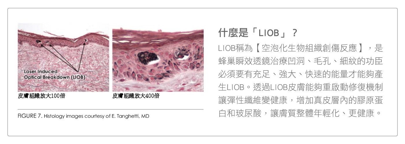 LIOB能夠讓皮膚重新啟動修復機制，優化彈性纖維的健康，並在真皮層內增加膠原蛋白和玻尿酸。