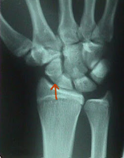 The scaphoid bone