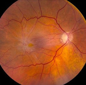 test eyesight E.R.M Disease Membrane EpiRetinal