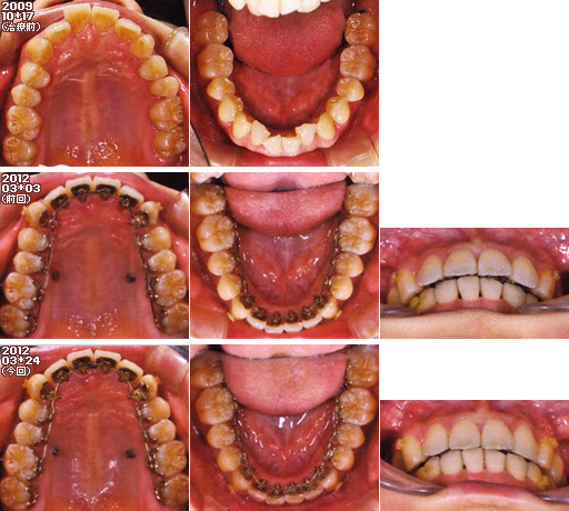 歯列矯正：定期検診その21