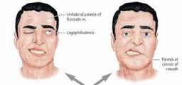 Cara Mengobati Stroke Yang Belum Parah