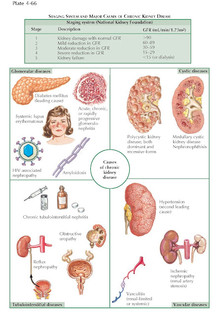 STAGING SYSTEM AND MAJOR CAUSES OF CHRONIC KIDNEY DISEASE