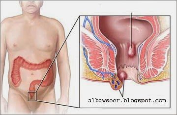مرض البواسير