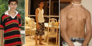 Zyzz Antes