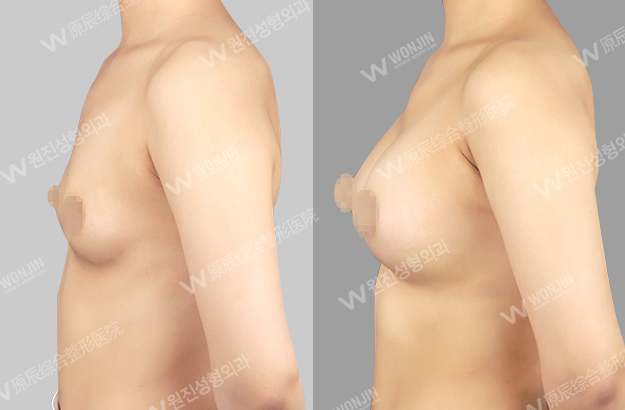 짱이뻐! - Before and After Photos Korean Breast Plastic Surgery