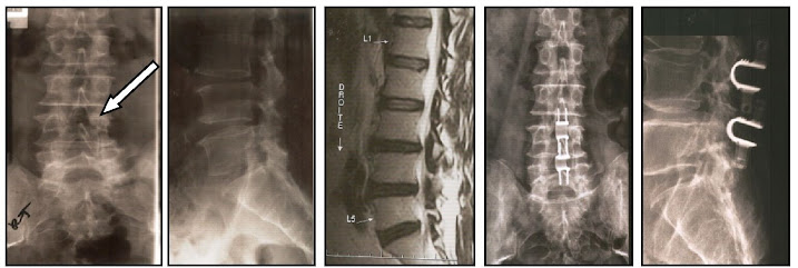 Interspinous Spacers