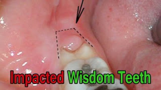 Impacted wisdom teeth