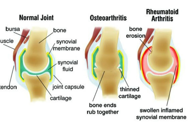Osteoarthritis and Rheumatoid arthritis