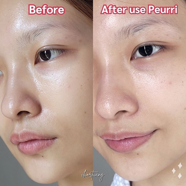 chortuang review peurri acne cleanser for sensitive skin รีวิว คลีนเซอร์ ลดสิว ผิวหน้า ผิวกาย สิว ผด ผื่น คัน สิวอักเสบ สิวหน้า สิวหลัง สิวบุก เจลล้างหน้า เจลทำความสะอาด