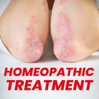 homeopathic psoriasis treatment