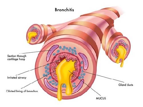 Bronchitis Homeopathic Clinic in Chennai