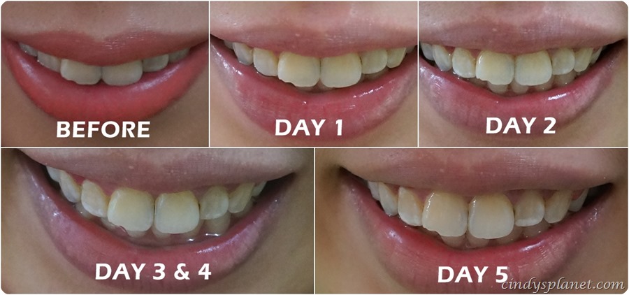 How to use opalescence tooth whitening system