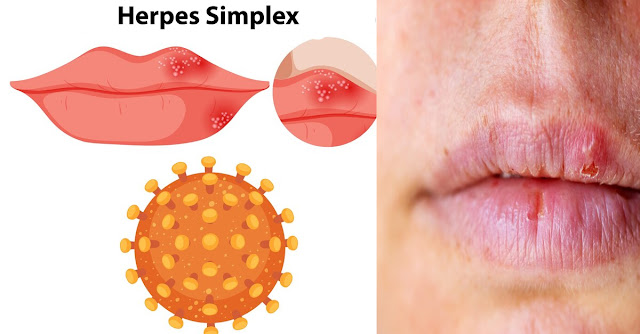 Herpes Simplex: Conheça os Sintomas