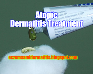 Atopic Dermatitis Treatment