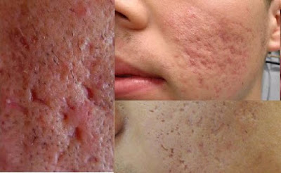 10 Tips Guaranteed to Remove Acne Scars Naturally