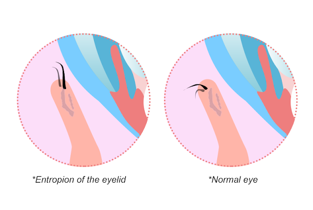 entropion  of the eyelid