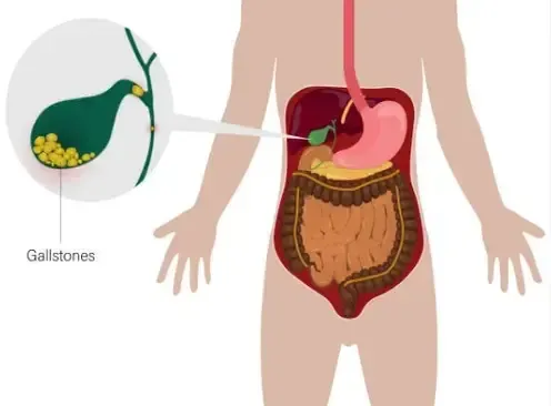 12 Signs that Your Gallbladder is in Danger: What You Need to Know
