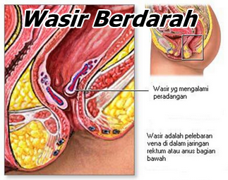 Jual Obat Wasir Pria Dan Wanita