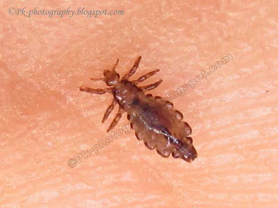 Head Lice Picture