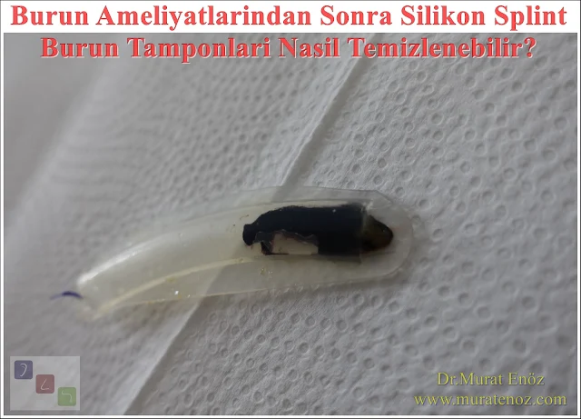Silikon burun tamponu nasıl çıkarılır? - Silikon tampon nefes alınır mı? - İnternal nazal silikon splint - Silikon splintlere bağlı hapşırma görülür mü? - Silikon burun tamponlarının hava deliği burun ameliyatı sonrasında tıkanır mı?