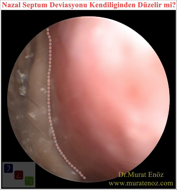 Nazal septum deviasyonu kendiliğinden düzelir mi? - Septum deviasyonu ilaçla düzelir mi? - Septum deviasyonu kendiliğinden düzelir mi? - Burun kıkırdak eğriliği için doğal çözüm - Burun kıkırdak eğriliği ilaçla düzelir mi?